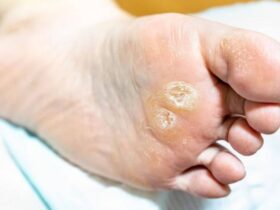 Comment enlever un durillon sous le pied Comment enlever un durillon sous le pied